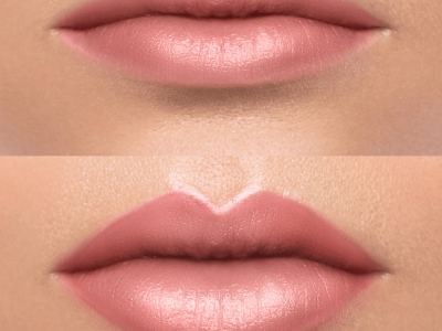 dermal-fillers-before-and-after